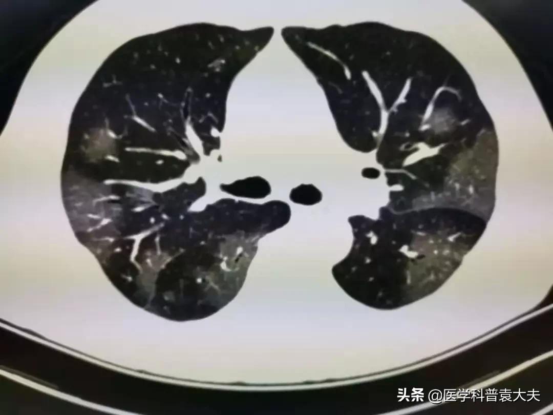 新冠肺炎最新消,新冠肺炎最新消息，全球态势、疫苗进展与科普解读